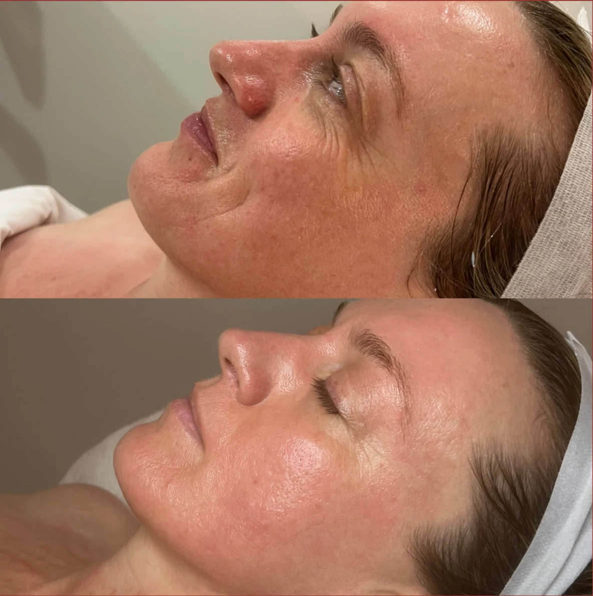 Before and after skin result — two-panel comparison showing skin improvement following LUNA treatment program